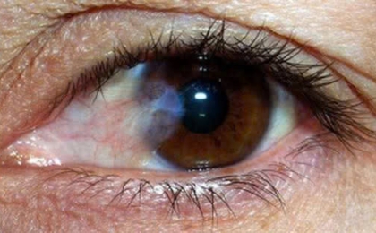 PHẪU THUẬT MỘNG GHÉP KẾT MẠC TỰ THÂN